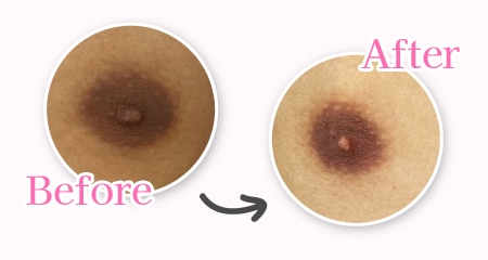 釧路 ドールピンク 脇の黒ずみ施術前